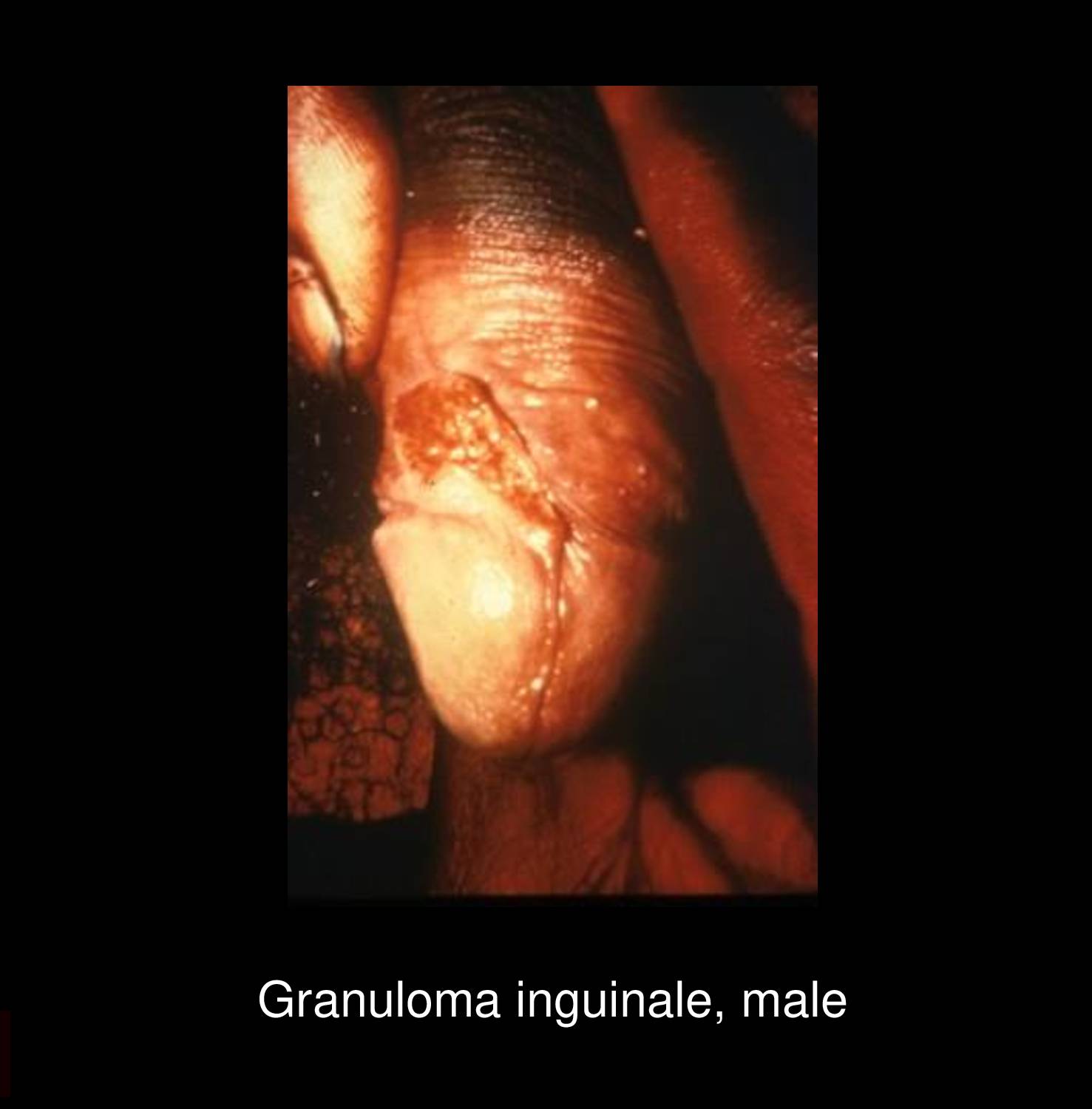 Granuloma inguinale beefy-red ulcer on male genitalia showing characteristic friable granulation tissue caused by Klebsiella granulomatis infection